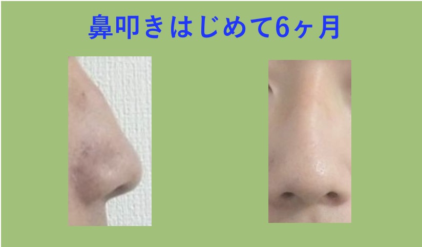 鼻たたきの効果（半年）